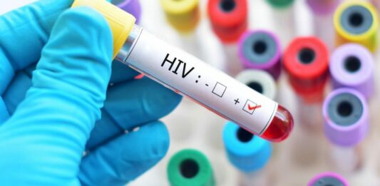 Descubren una nueva variante del VIH más virulenta que circula en Países Bajos