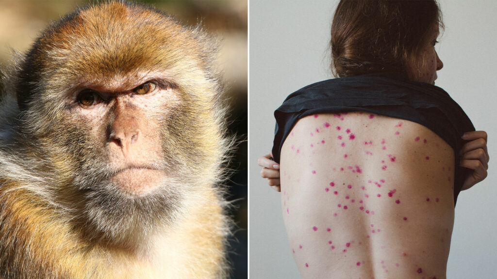 Al momento se notificaron 92 casos de viruela del mono confirmados por laboratorio y 28 casos sospechosos en el mundo. 